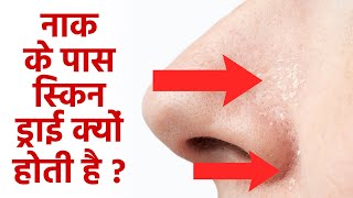 नाक के आसपास ड्राई स्किन क्यों होती है  Naak Ke Pass Dry Skin Kyu Hoti Hai  Boldsky [upl. by Olva595]