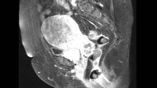 Decidua the pregnant endometrium Understanding Its Crucial Role in Embryology [upl. by Yanetruoc]