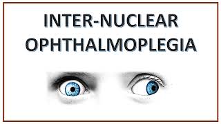 Internuclear Ophthalmoplegia  INO  WEBINO Syndrome  One and Half Syndrome [upl. by Spears423]