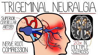 Understanding Trigeminal Neuralgia [upl. by Gninnahc522]