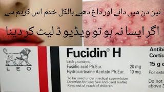 Fucidin H Cream Honest reviewFucidin Cream Best For treatment acne Scar Skin [upl. by Vernon]