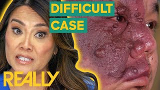 Dr Lee Calls For Backup To Tackle An Extreme Case  Dr Pimple Popper [upl. by Ecnerol]