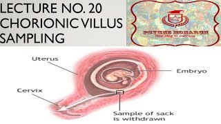 chorionic villus sampling in urdu [upl. by Nancey]