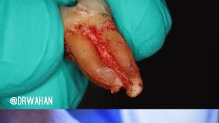 Molar Extraction with Help From Cowhorn Forceps [upl. by Jary839]