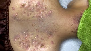 Big Cystic Acne Blackheads Extraction Blackheads amp Milia Whiteheads Removal Pimple Popping  5324 [upl. by Saticilef374]