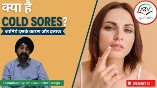 Cold Sores Explained by Dr Gurvinder Banga Causes Symptoms and Treatment [upl. by Suhail]