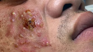 Big Cystic Acne Blackheads Extraction Blackheads amp Milia Whiteheads Removal Pimple Popping  2692 [upl. by Alby155]