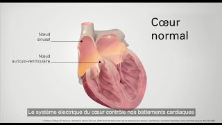 La fibrillation atriale  Le Cœur lors de FA [upl. by Nivert]