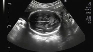 Ultrasound video showing dilated lateral as well as 3rd ventricles of the fetus [upl. by Naie969]