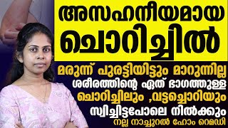 വട്ടച്ചൊറിയും ചൊറിച്ചിലും മാറ്റാൻ നല്ല നാച്ചുറൽ ഹോം റെമഡി ഇതാChorichil Maattaan [upl. by Eenej518]