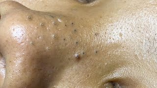 Big Cystic Acne Blackheads Extraction Blackheads amp Milia Whiteheads Removal Pimple Popping  1074 [upl. by Illoh]