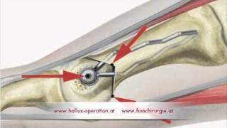 Hallux Operation nach Stoffella Teil 23 Osteotomie [upl. by Rosabella844]