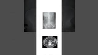 Case number 6 riglers Triad Look at the description for viva questionsviva casestudyradiology [upl. by Spracklen]