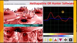 Atheromatous Aorta Medicomat Aorta Treatment [upl. by Haym704]