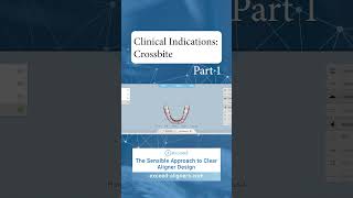 Clinical Indications Crossbite Part 1 [upl. by Parke]