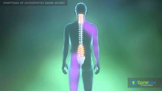 Osteophytes bone spurs Symptoms [upl. by Assilram]