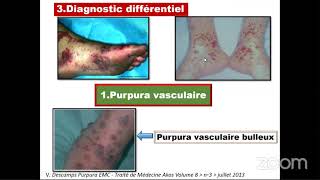 🔴Hématologie Pathologies de lhémostase [upl. by Efren280]