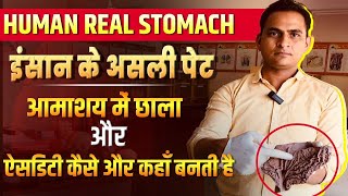 FullVideoAcidity amp Gastric Ulcer in Real Stomach  इंसान के असली पेट में ऐसिडिटी और छाले viral [upl. by Etom707]