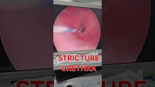 How stricture urethra look urethralstricturetreatment urethralstricture strictureurethra [upl. by Ijies383]