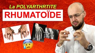 Les symptômes de la POLYARTHRITE RHUMATOÏDE [upl. by Anillek]