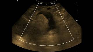 Complex Adnexal Mass  Dermoid Cyst  Ultrasound  Case 23 [upl. by Iives]