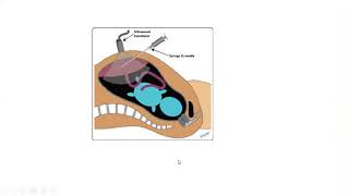 CVS procedure  Chorionic Villus Sampling in Tamil [upl. by Dichy]