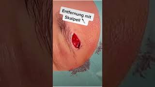 Muttermal im Gesicht entfernen – die OP 🔪 shorts plasticsurgery [upl. by Trenton]