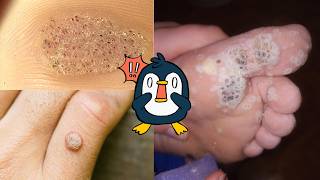 What causes warts and how to get rid of them [upl. by Eimaj]