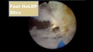 Holmium laser enucleation HoLEP Case 17 [upl. by Angelika]