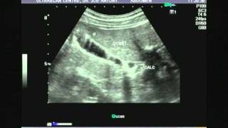 adenomyomatosisvideo1bmpg [upl. by Adalia]