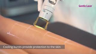 Laser Hair Removal  Candela GentleMax Pro [upl. by Muirhead]