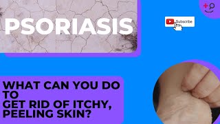 Psoriasis Treatments for You Get Rid of That Itchy Painful Rash [upl. by Gretta]