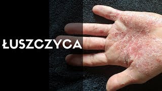 Dermatolog mówi o ŁUSZCZYCA [upl. by Blackwell]