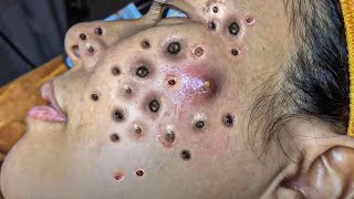 Big Cystic Acne Blackheads Extraction Blackheads amp Milia Whiteheads Removal Pimple Popping  424 [upl. by Nytsrik]