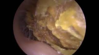 244  16 cm Measured LUMP of Solid Ear Wax Removed using Microsuction  Mr Neel Raithatha THC [upl. by Kieger]