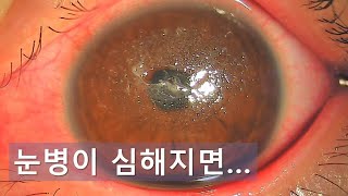 눈병이 심해지면Epidemic keratoconjunctivitis [upl. by Nazar807]