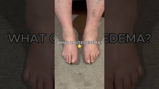 What is the cause of edema [upl. by Ettennan]