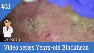 13 Video series Years old Blackhead Facial [upl. by Carlotta]