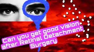 14 Can you get good VISION after Retinal Detachment Surgery RETINAL DETACHMENTretinaldetachment [upl. by Poliard]