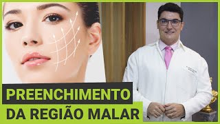 Harmonização Facial através do Preenchimento da Região Malar com Ácido Hialurônico acidohialuronico [upl. by Idou]