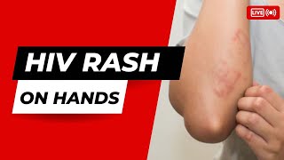 HIV Rash on Hands [upl. by Olracnaig875]