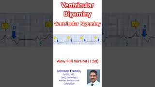 Ventricular Bigeminy [upl. by Serena]