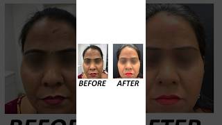 ✨ Scar Surgery Treatment by Dr Anvika Achieve Smooth ScarFree Skin ✨ scar scartreatment [upl. by Hoes]