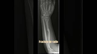 fracturas fracturabrazo fracturaradio medicina radiologia radiologo radiografia [upl. by Ragse]