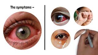 Pink Eye symptoms and treatment for Conjunctivitis [upl. by Ahsha268]