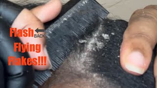 Dandruff Scratching Psoriasis Scalp Lots of Stubborn Crunchy Flakes Popping [upl. by Waller]