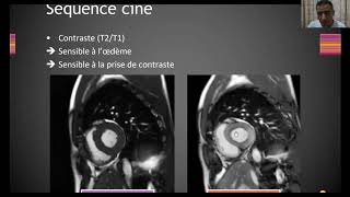 IRM cardiaque  Cardiopathie ischémique [upl. by Anatola294]