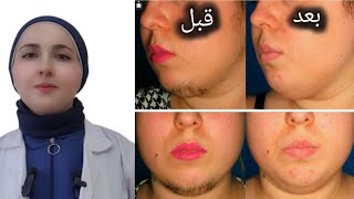 أفضل الطرق لإزالة الشعر الكثيف في الوجهface hair removal [upl. by Oidgime195]