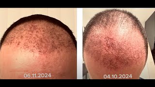 Haartransplantation Türkei  Update 2 Monat [upl. by Summons394]