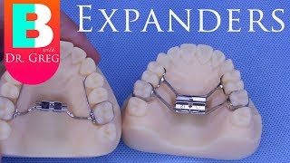 BRACES EXPLAINED Palatal Expanders [upl. by Rip]